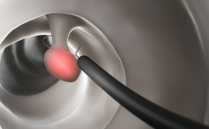 日帰り大腸ポリープ切除